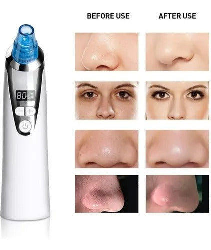 Removedor de Espinillas Aspirador al Vacío con Exfoliación